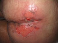 Graad 2 decubitus (ontvelling)