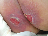 Grade 3 pressure ulcer