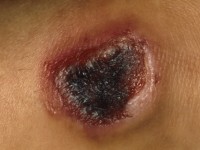 Grade 3 pressure ulcer