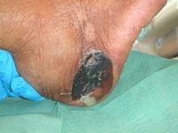 Graad 3 decubitus (huiddefect met schade of necrose van huid en onderhuids weefsel)