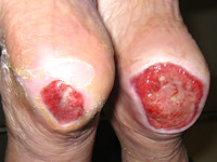 Graad 3 decubitus (huiddefect met schade of necrose van huid en onderhuids weefsel)