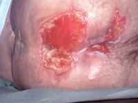 Graad 3 decubitus (huiddefect met schade of necrose van huid en onderhuids weefsel)