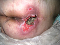 Graad 4 decubitus (diepe necrose tot aan vitale structuren)