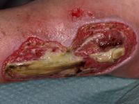 Graad 4 decubitus (diepe necrose tot aan vitale structuren)