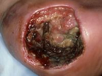 Graad 4 decubitus (diepe necrose tot aan vitale structuren)