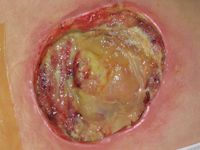 Graad 4 decubitus (diepe necrose tot aan vitale structuren)