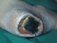 Graad 4 decubitus (diepe necrose tot aan vitale structuren)