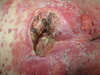 Graad 4 decubitus (diepe necrose tot aan vitale structuren)