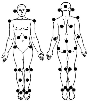 Voorkeurslokalisaties decubitus over bot