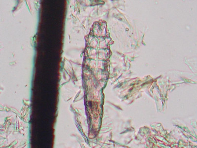 Demodex folliculorum