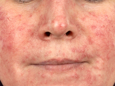 Demodex folliculitis