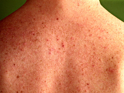 Demodex folliculitis