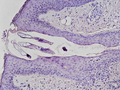 Demodex folliculitis