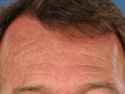 Demodex folliculitis