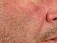 Demodex folliculitis