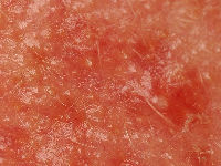 Demodex folliculitis