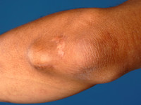 adipositas dolorosa (Dercum disease)