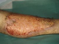 Dermatitis artefacta