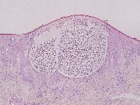 Dermatitis artefacta