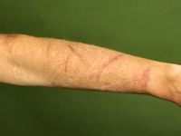 Dermatitis artefacta