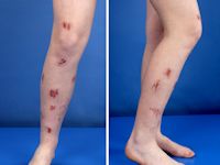 Dermatitis artefacta