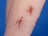 Dermatitis artefacta