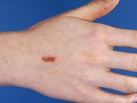 Dermatitis artefacta