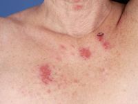Dermatitis artefacta