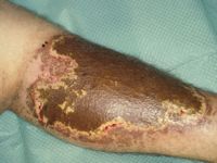 Dermatitis artefacta