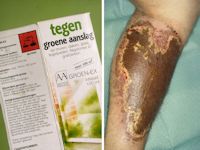 Dermatitis artefacta