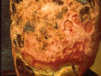 Dermatitis artefacta