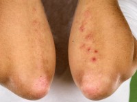 Dermatitis herpetiformis, Duhring's disease