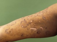 Dermatitis herpetiformis, Duhring's disease