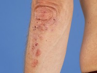 Dermatitis herpetiformis, Duhring's disease