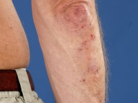 Dermatitis herpetiformis, Duhring's disease