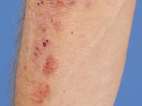 Dermatitis herpetiformis, Duhring's disease