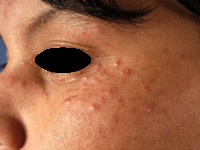 Dermatitis periorbitalis