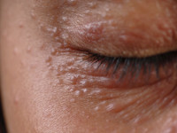 Dermatitis periorbitalis