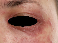 Dermatitis periorbitalis