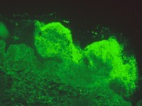 IgA depositie in de immunofluorescentie van lesionale huid
