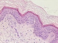 PA lesionale huid (subepidermale microabcesjes)