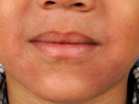 Perioral dermatitis
