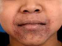 Dermatitis perioralis