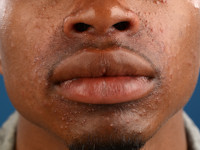 Perioral dermatitis