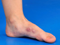 Dermatofibrosarcoma protuberans