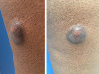 Dermatofibrosarcoma protuberans