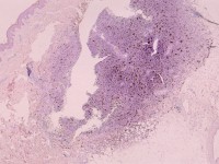Dermatofibrosarcoma protuberans