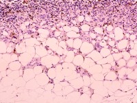 Dermatofibrosarcoma protuberans