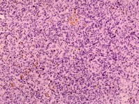Dermatofibrosarcoma protuberans
