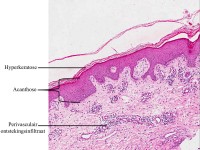 Dermatomycose, HE kleuring